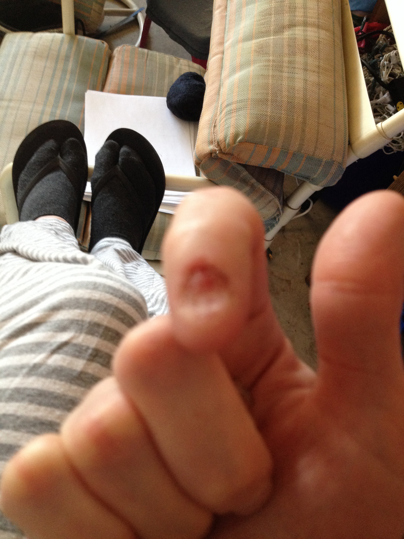 Illustration for article titled A gross post about my gross nail - HALP!